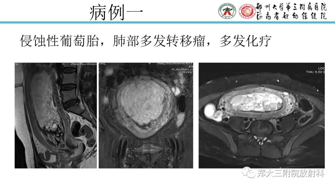 影像PPT - 【PPT】滋养细胞疾病的影像诊断-47