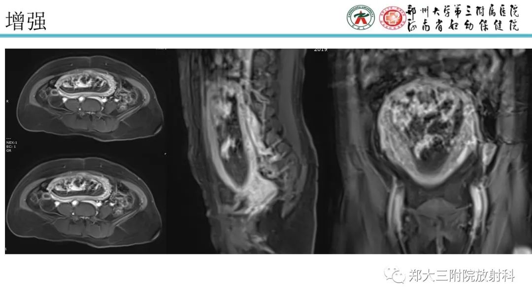 影像PPT - 【PPT】滋养细胞疾病的影像诊断-48