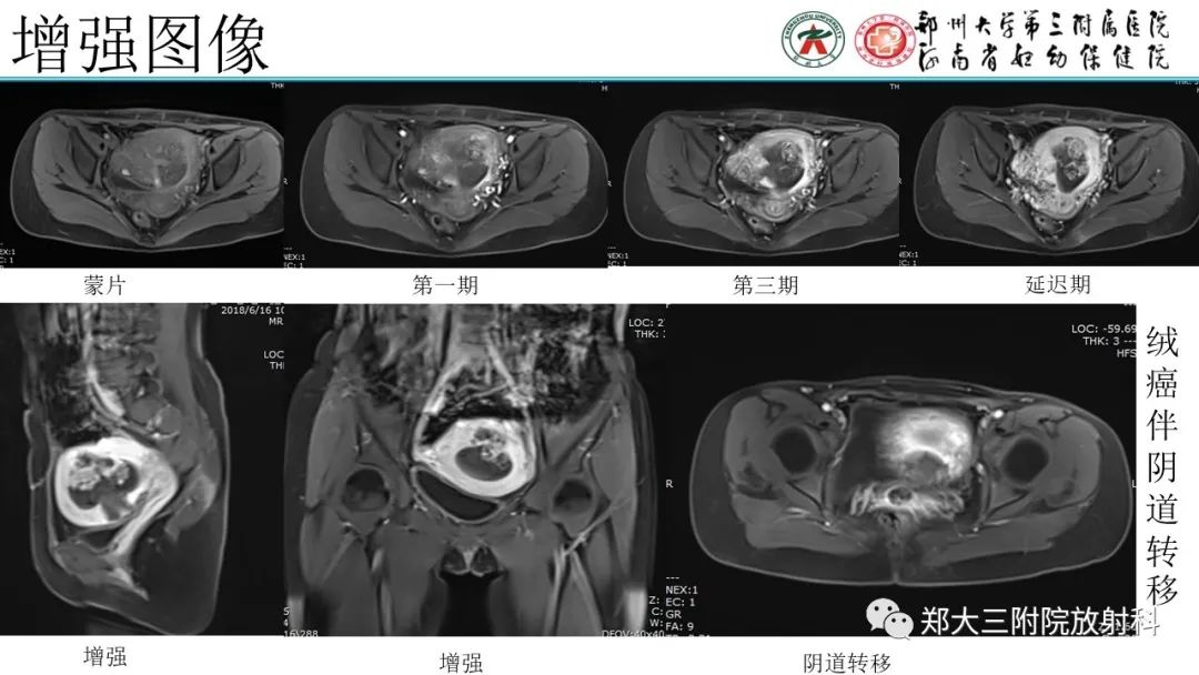 影像PPT - 【PPT】滋养细胞疾病的影像诊断-51