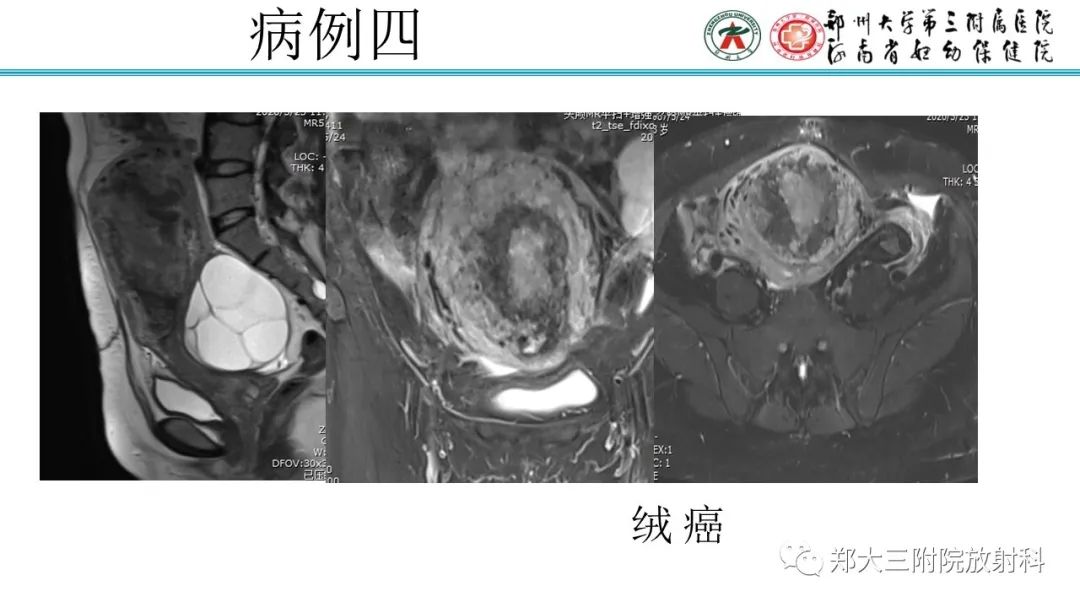 影像PPT - 【PPT】滋养细胞疾病的影像诊断-53