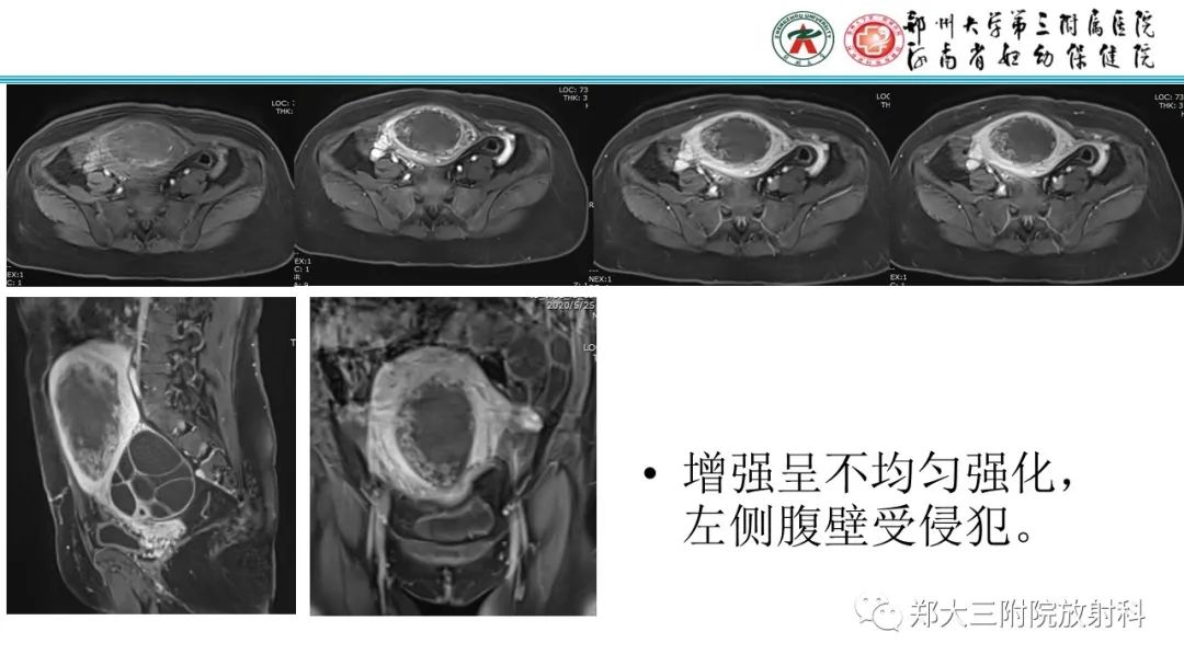 影像PPT - 【PPT】滋养细胞疾病的影像诊断-54