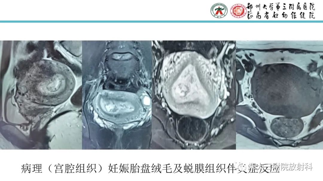 影像PPT - 【PPT】滋养细胞疾病的影像诊断-58