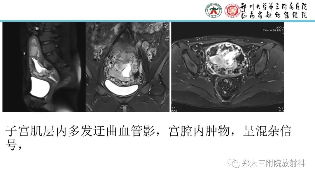 影像PPT - 【PPT】滋养细胞疾病的影像诊断-62