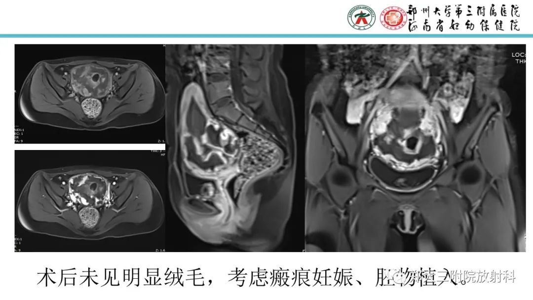 影像PPT - 【PPT】滋养细胞疾病的影像诊断-63
