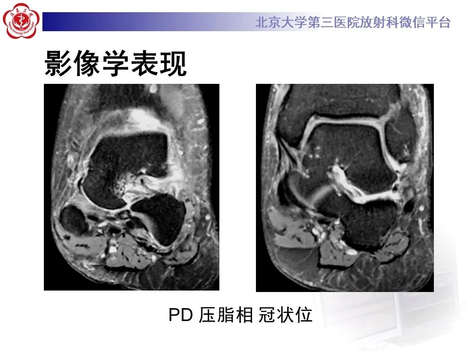 影像PPT - 【PPT】跗骨窦综合征-3