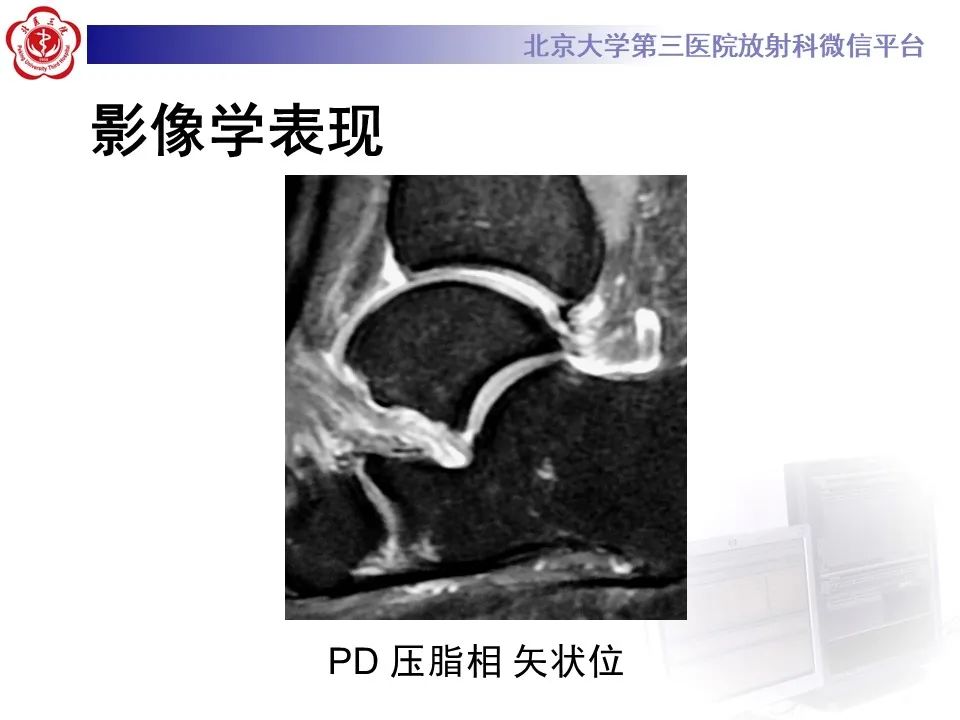 影像PPT - 【PPT】跗骨窦综合征-5