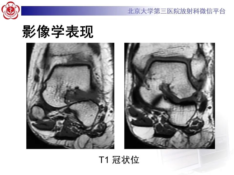 影像PPT - 【PPT】跗骨窦综合征-4