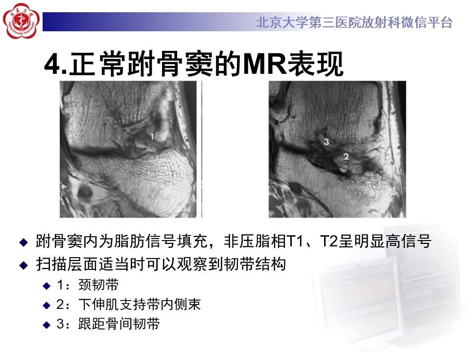 影像PPT - 【PPT】跗骨窦综合征-12