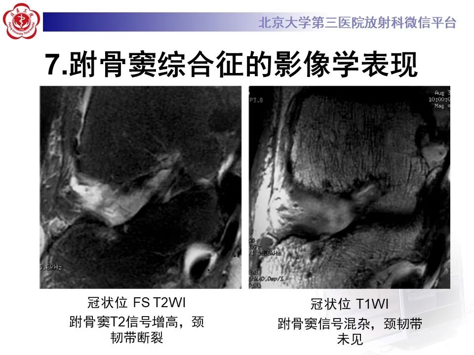 影像PPT - 【PPT】跗骨窦综合征-17