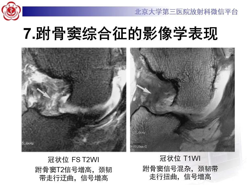 影像PPT - 【PPT】跗骨窦综合征-18