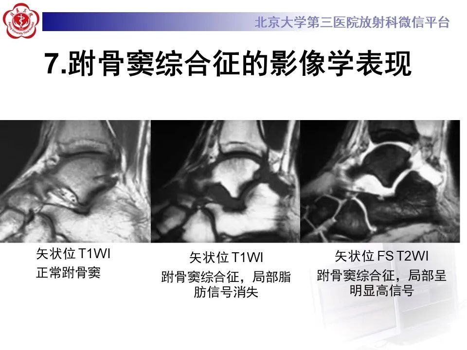 影像PPT - 【PPT】跗骨窦综合征-16
