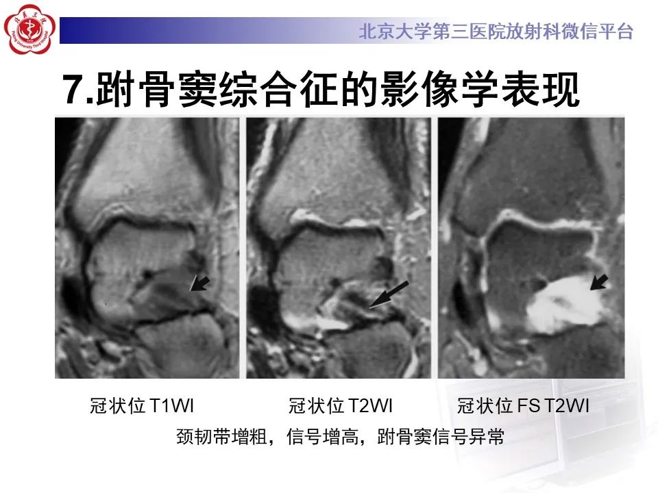 影像PPT - 【PPT】跗骨窦综合征-19