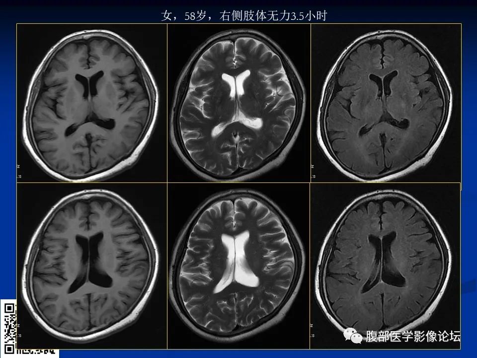 影像PPT - 【PPT】早期脑梗死MR诊断的一点体会-7