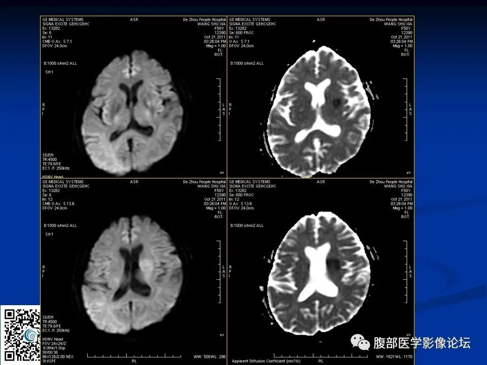 影像PPT - 【PPT】早期脑梗死MR诊断的一点体会-8