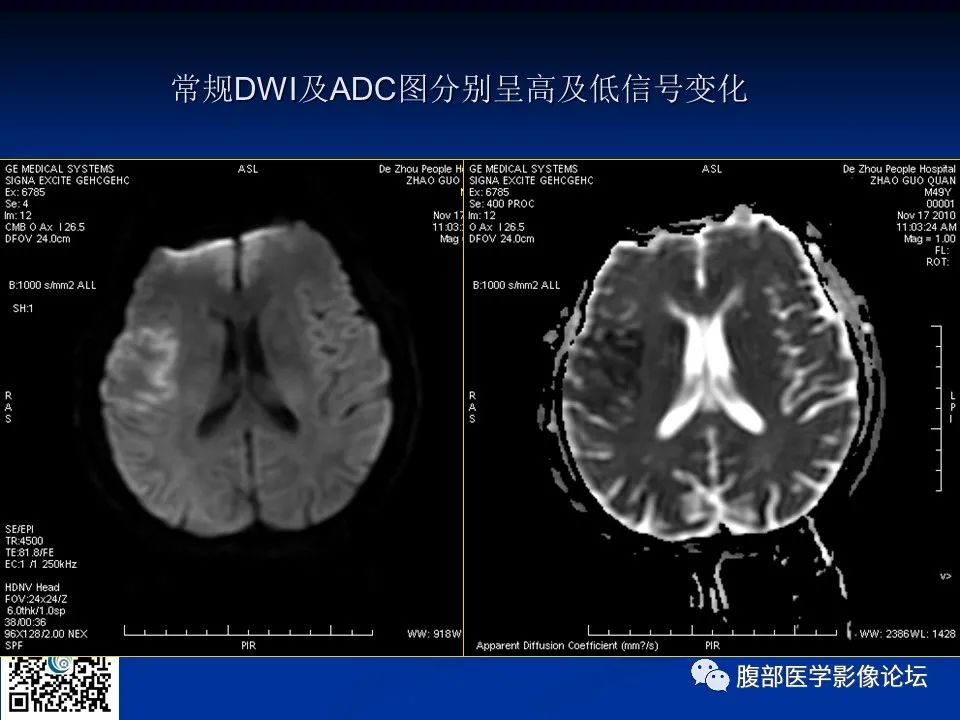 影像PPT - 【PPT】早期脑梗死MR诊断的一点体会-10