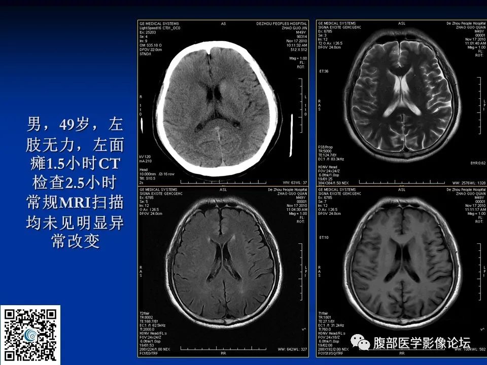 影像PPT - 【PPT】早期脑梗死MR诊断的一点体会-9