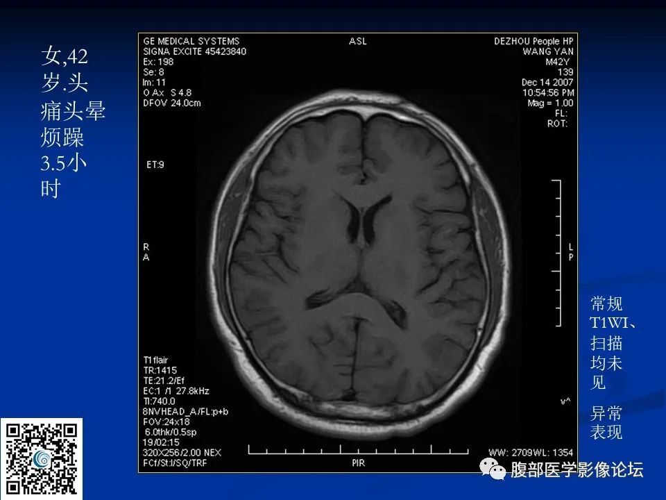 影像PPT - 【PPT】早期脑梗死MR诊断的一点体会-11