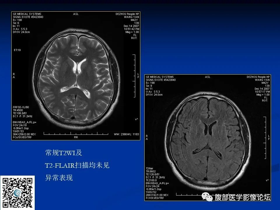 影像PPT - 【PPT】早期脑梗死MR诊断的一点体会-12