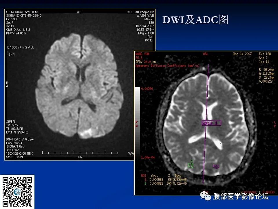 影像PPT - 【PPT】早期脑梗死MR诊断的一点体会-13