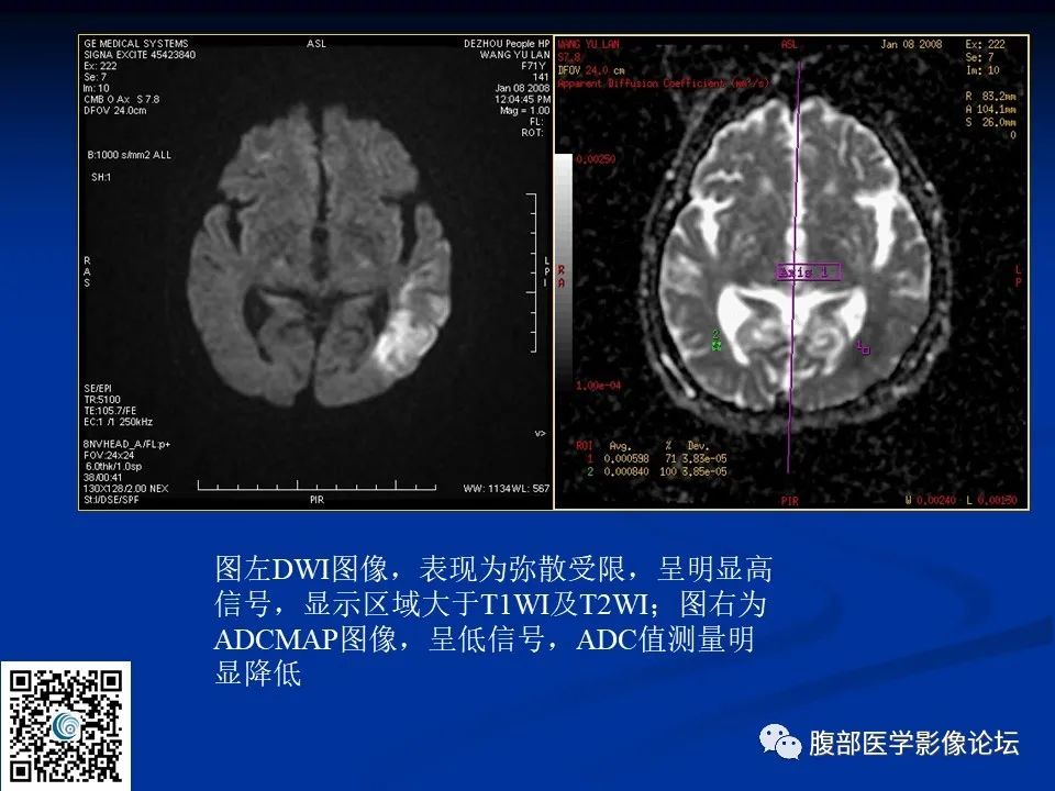 影像PPT - 【PPT】早期脑梗死MR诊断的一点体会-22