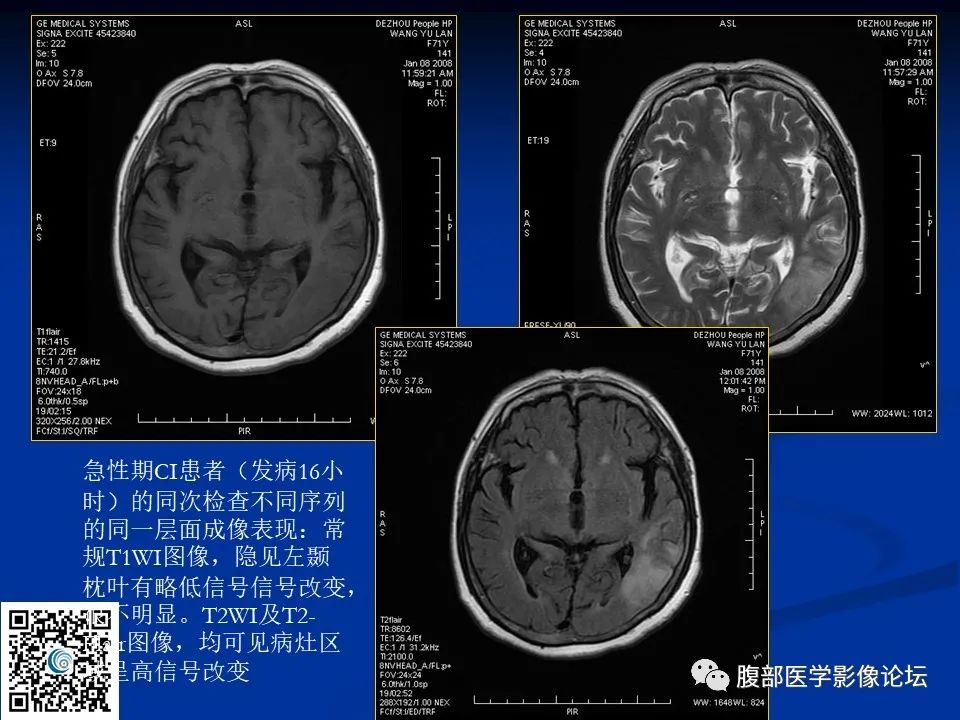 影像PPT - 【PPT】早期脑梗死MR诊断的一点体会-21