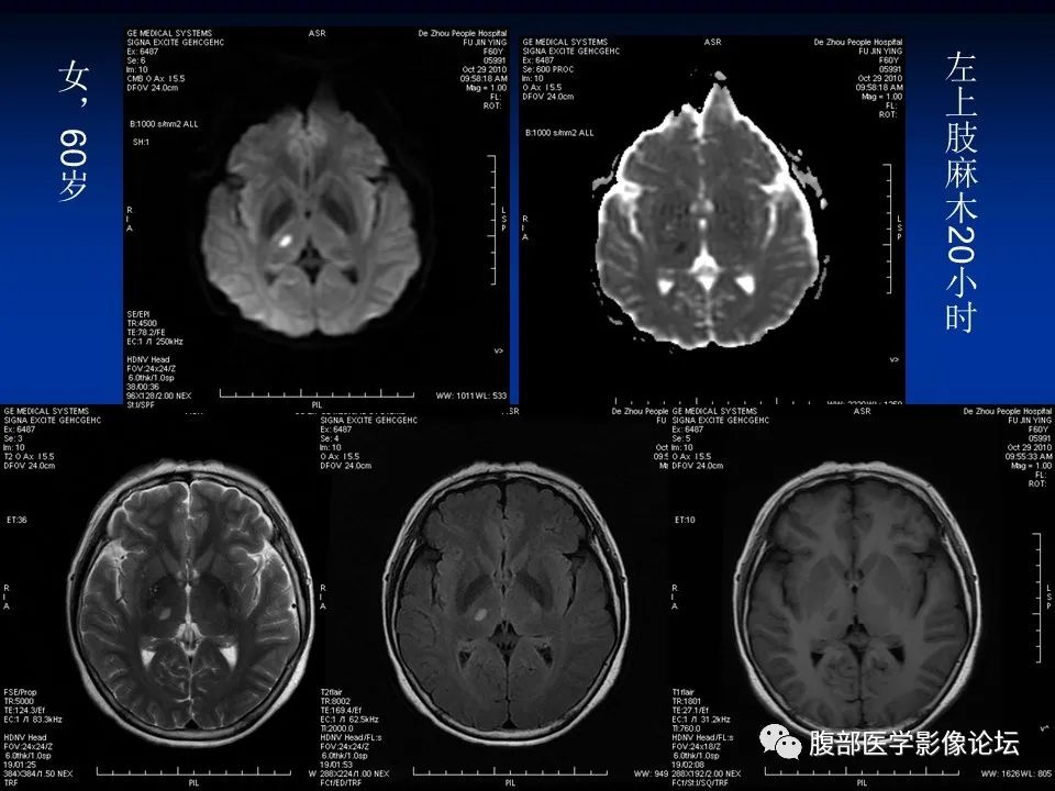 影像PPT - 【PPT】早期脑梗死MR诊断的一点体会-23
