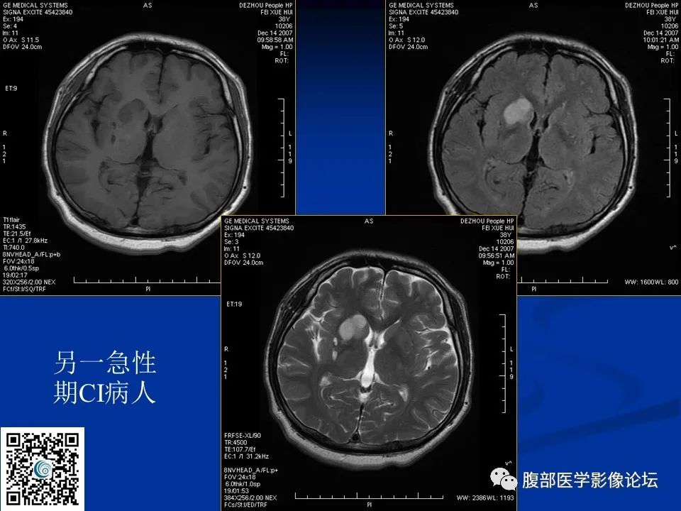 影像PPT - 【PPT】早期脑梗死MR诊断的一点体会-24