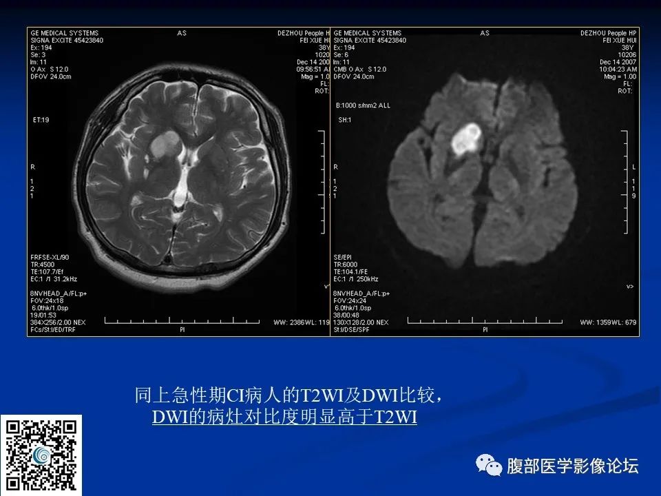 影像PPT - 【PPT】早期脑梗死MR诊断的一点体会-25