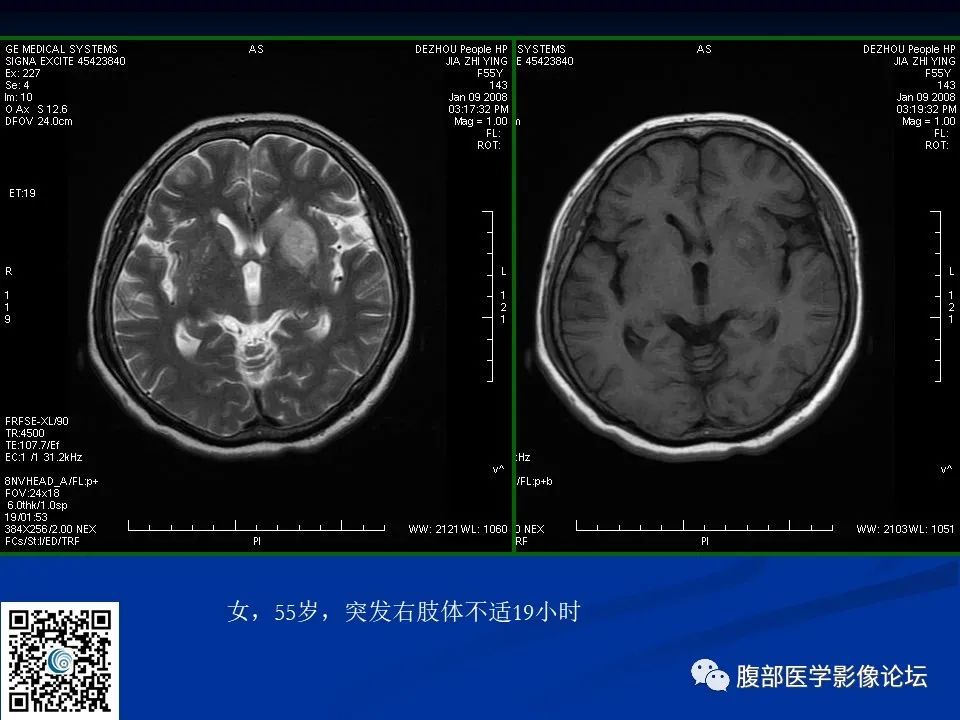 影像PPT - 【PPT】早期脑梗死MR诊断的一点体会-26