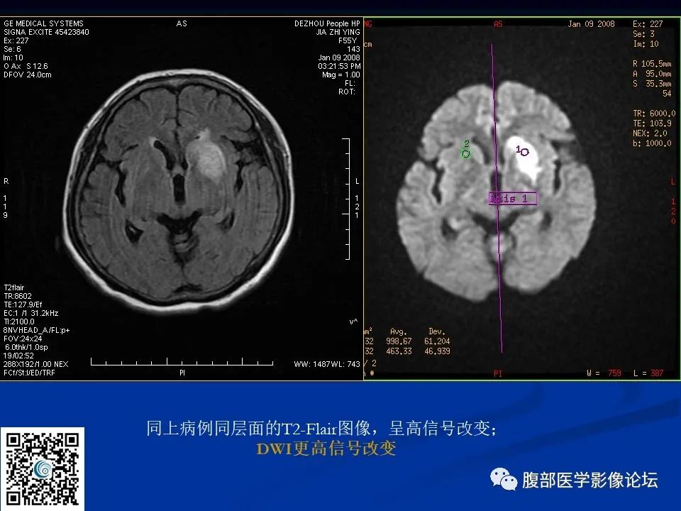 影像PPT - 【PPT】早期脑梗死MR诊断的一点体会-27