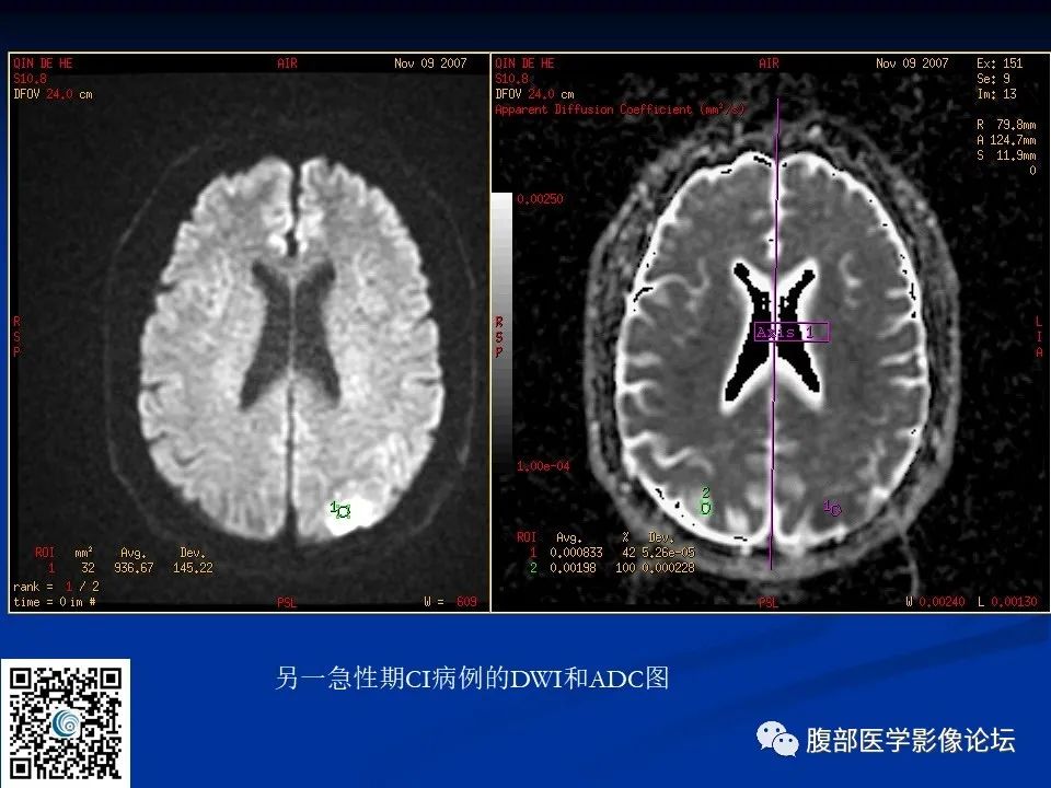 影像PPT - 【PPT】早期脑梗死MR诊断的一点体会-29