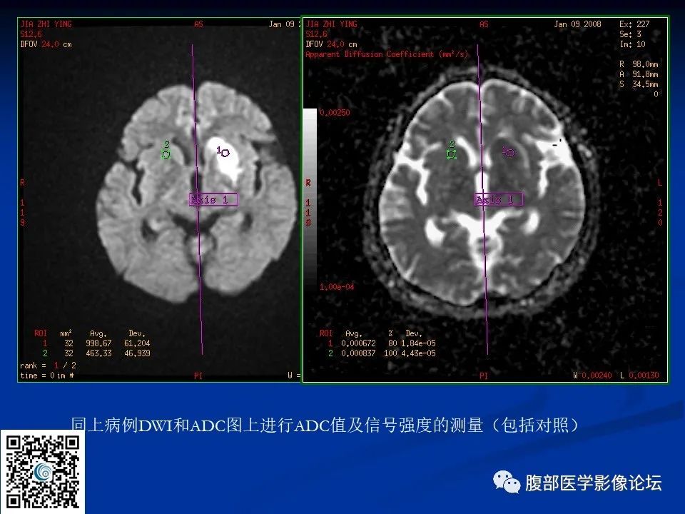 影像PPT - 【PPT】早期脑梗死MR诊断的一点体会-28