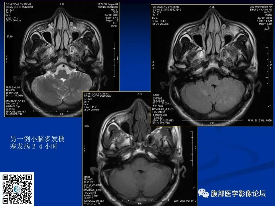 影像PPT - 【PPT】早期脑梗死MR诊断的一点体会-30
