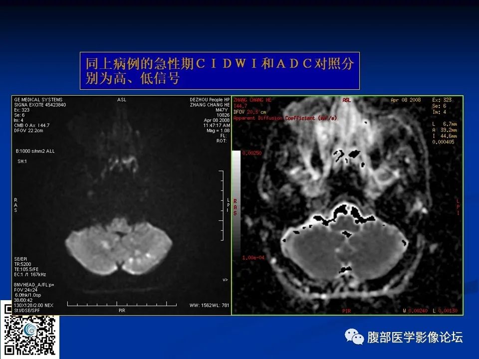 影像PPT - 【PPT】早期脑梗死MR诊断的一点体会-31