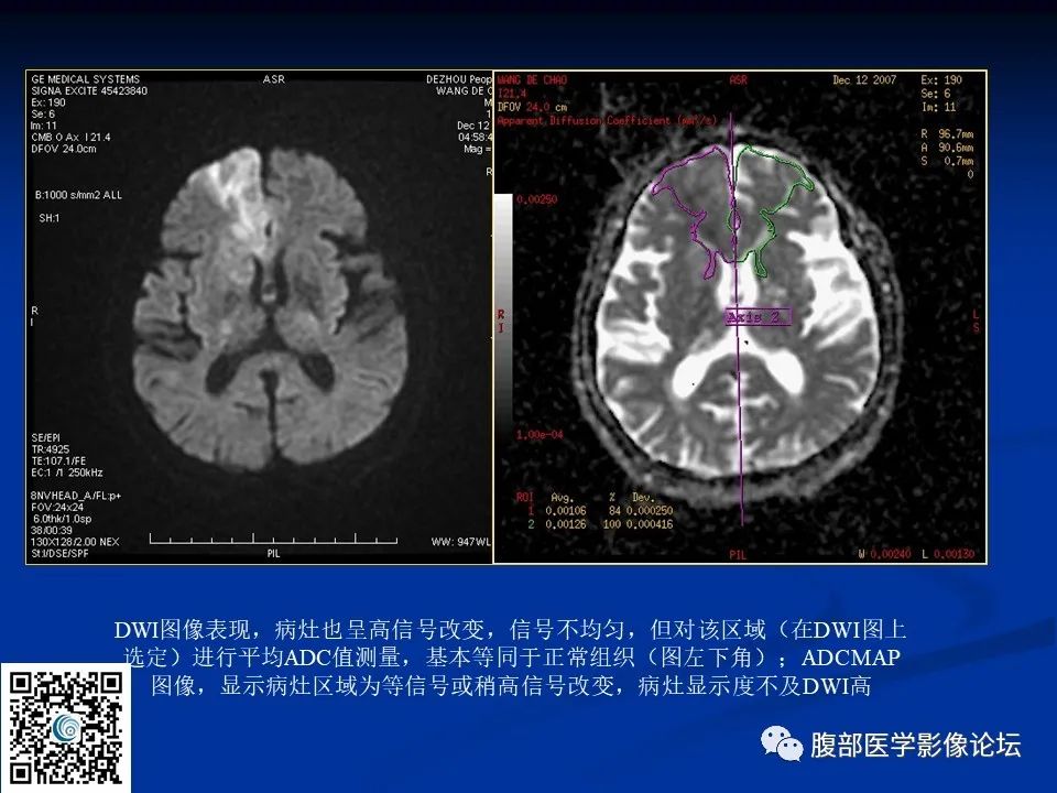 影像PPT - 【PPT】早期脑梗死MR诊断的一点体会-42