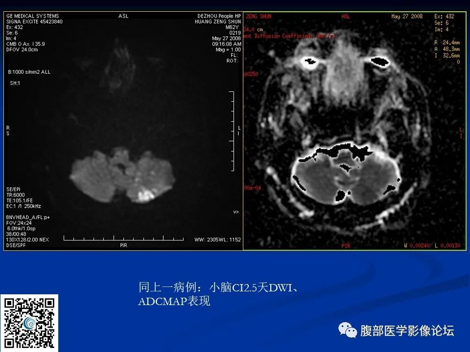 影像PPT - 【PPT】早期脑梗死MR诊断的一点体会-40