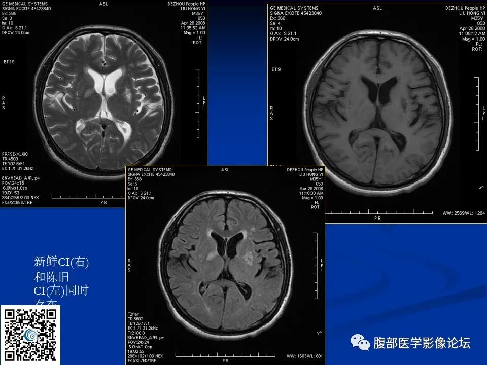 影像PPT - 【PPT】早期脑梗死MR诊断的一点体会-43