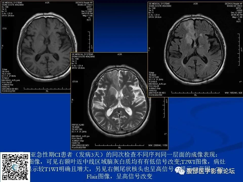 影像PPT - 【PPT】早期脑梗死MR诊断的一点体会-41