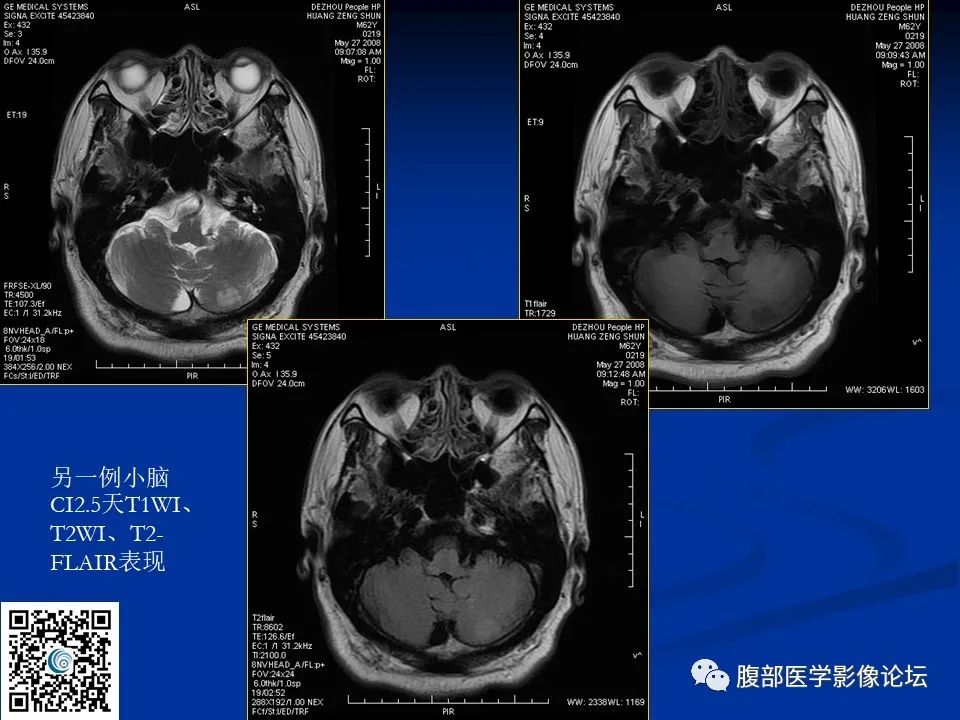 影像PPT - 【PPT】早期脑梗死MR诊断的一点体会-39