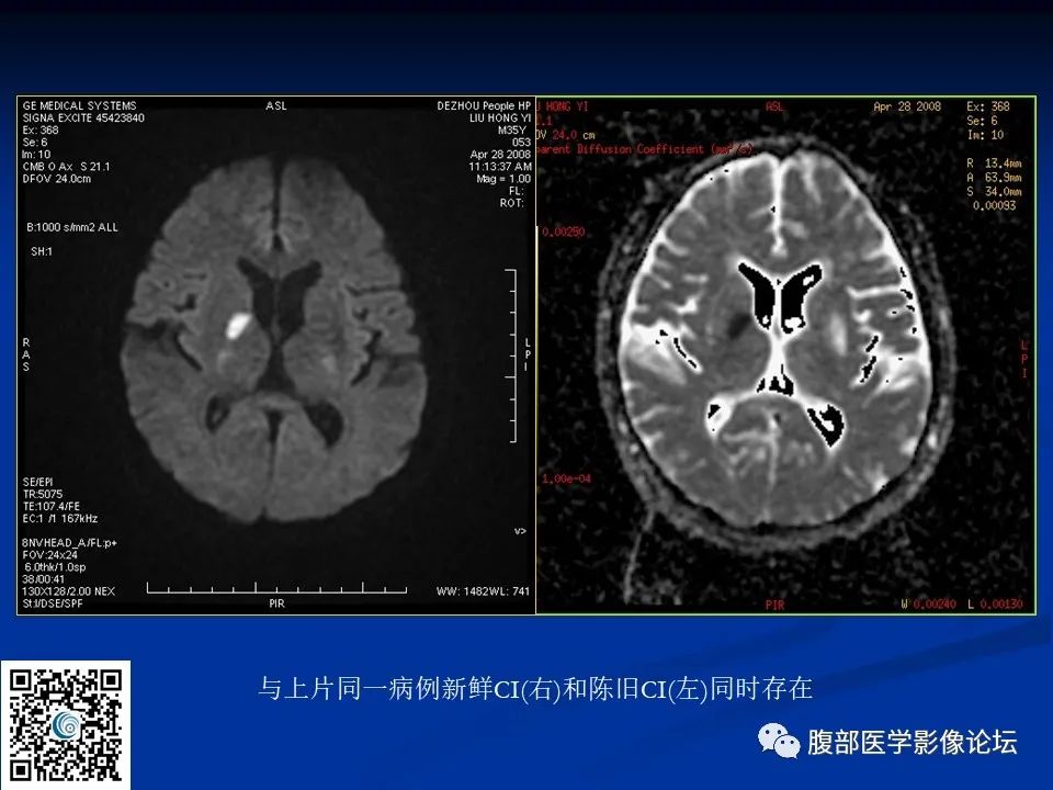 影像PPT - 【PPT】早期脑梗死MR诊断的一点体会-44