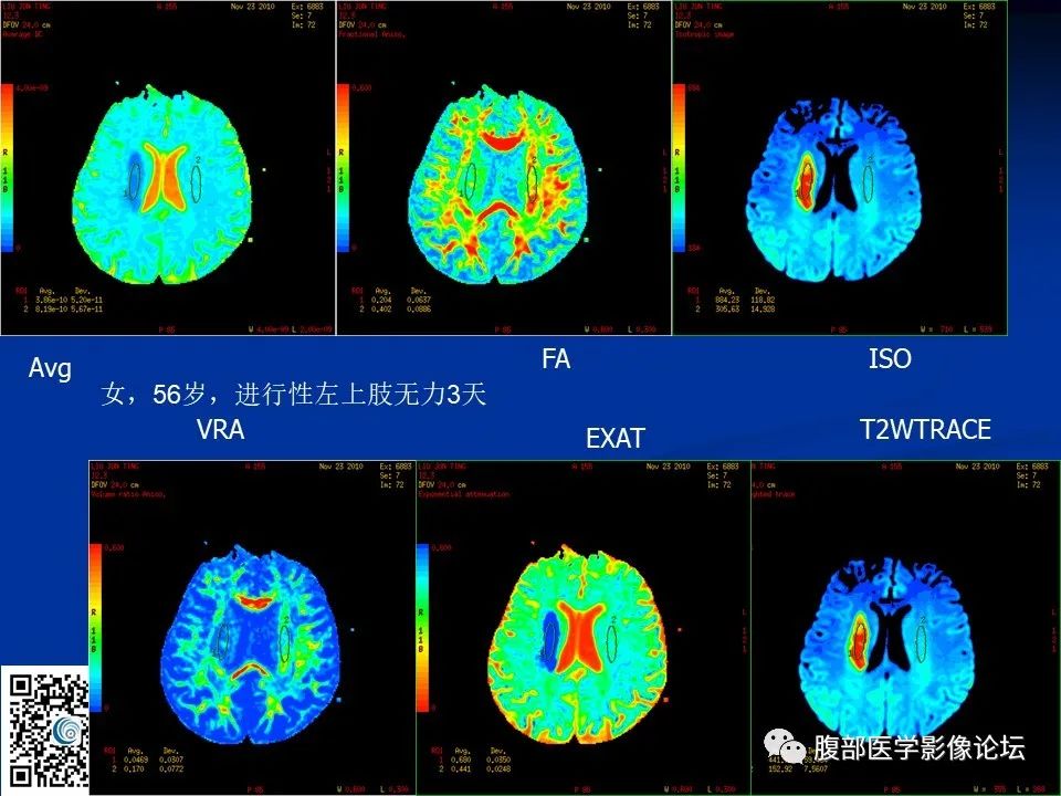 影像PPT - 【PPT】早期脑梗死MR诊断的一点体会-70