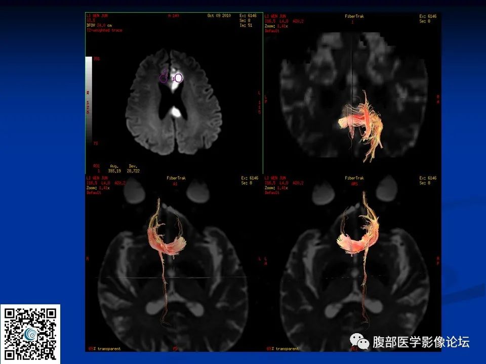 影像PPT - 【PPT】早期脑梗死MR诊断的一点体会-71