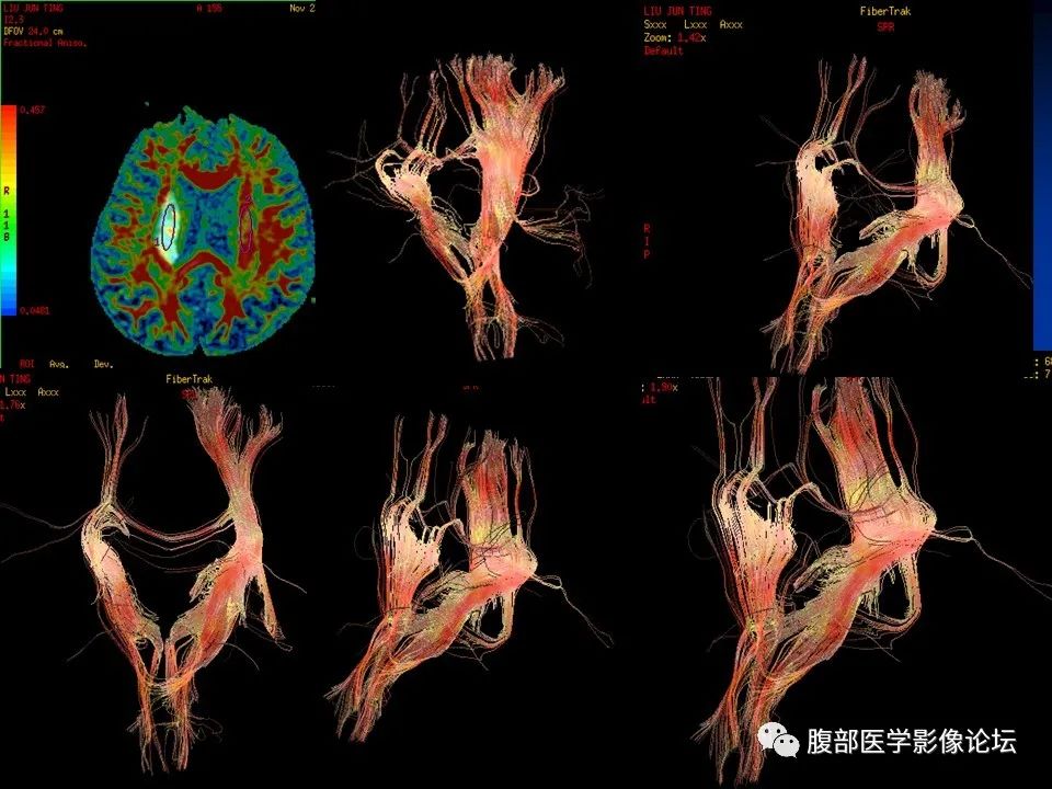 影像PPT - 【PPT】早期脑梗死MR诊断的一点体会-72