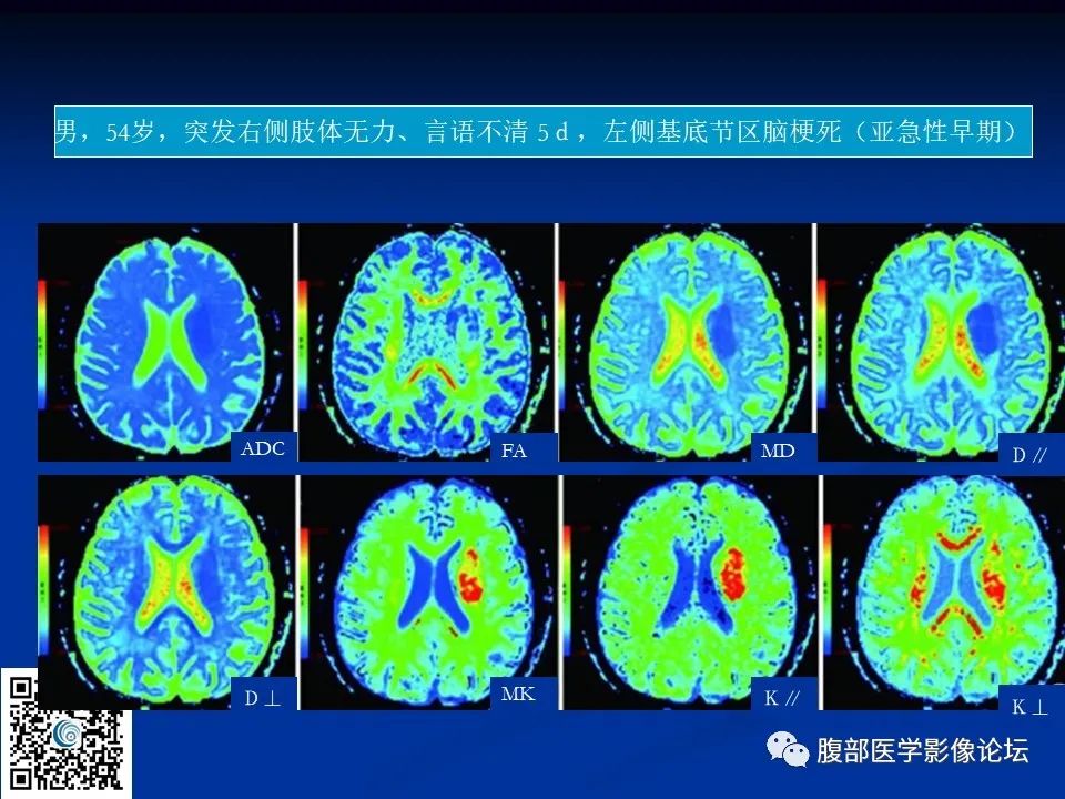 影像PPT - 【PPT】早期脑梗死MR诊断的一点体会-77