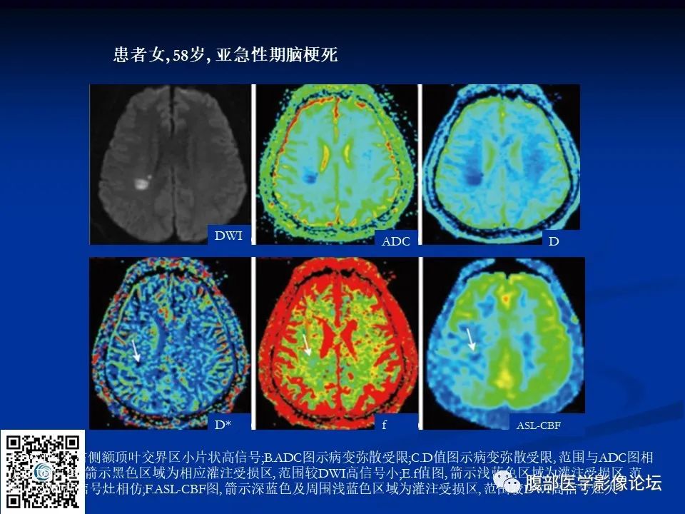 影像PPT - 【PPT】早期脑梗死MR诊断的一点体会-79
