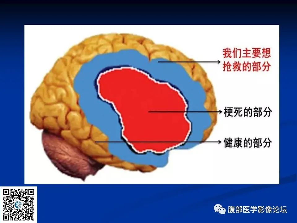 影像PPT - 【PPT】早期脑梗死MR诊断的一点体会-86