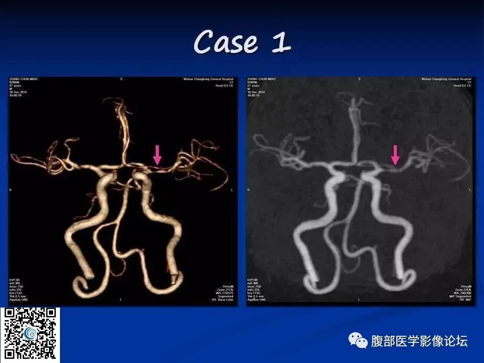 影像PPT - 【PPT】早期脑梗死MR诊断的一点体会-87