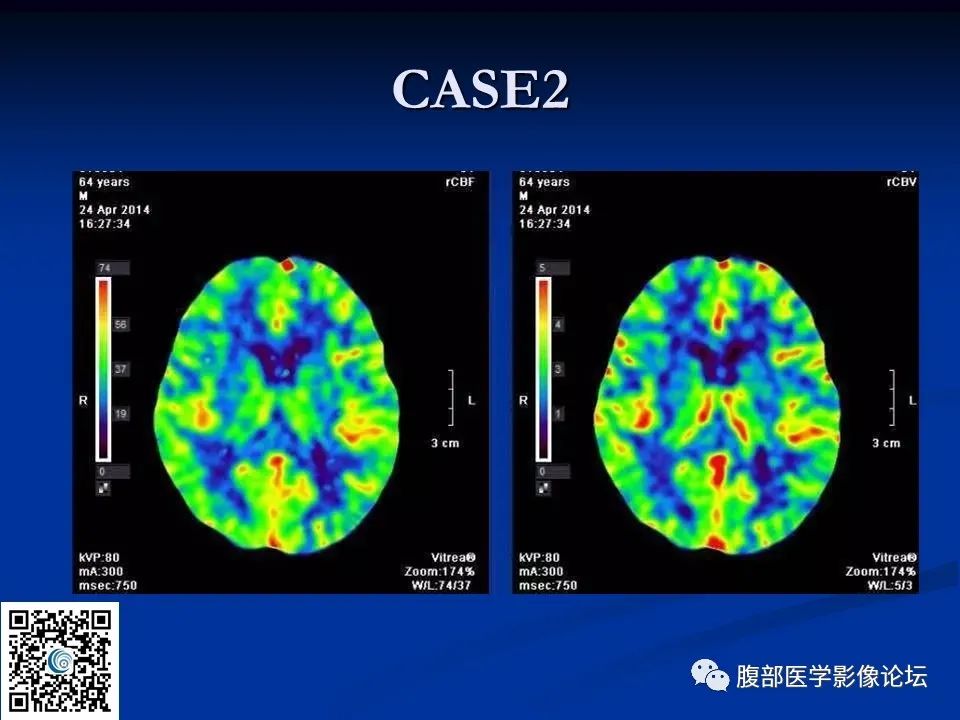 影像PPT - 【PPT】早期脑梗死MR诊断的一点体会-89