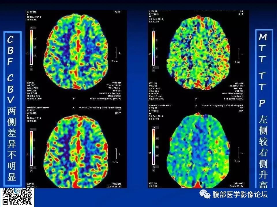 影像PPT - 【PPT】早期脑梗死MR诊断的一点体会-88