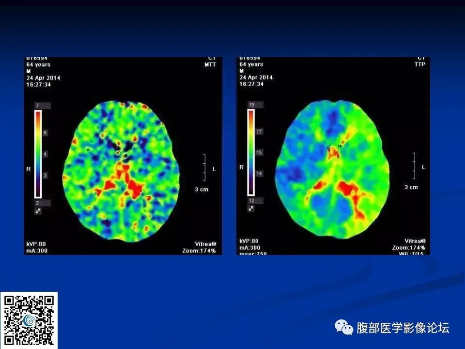 影像PPT - 【PPT】早期脑梗死MR诊断的一点体会-90